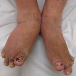 Psoriatic Arthritis Picture