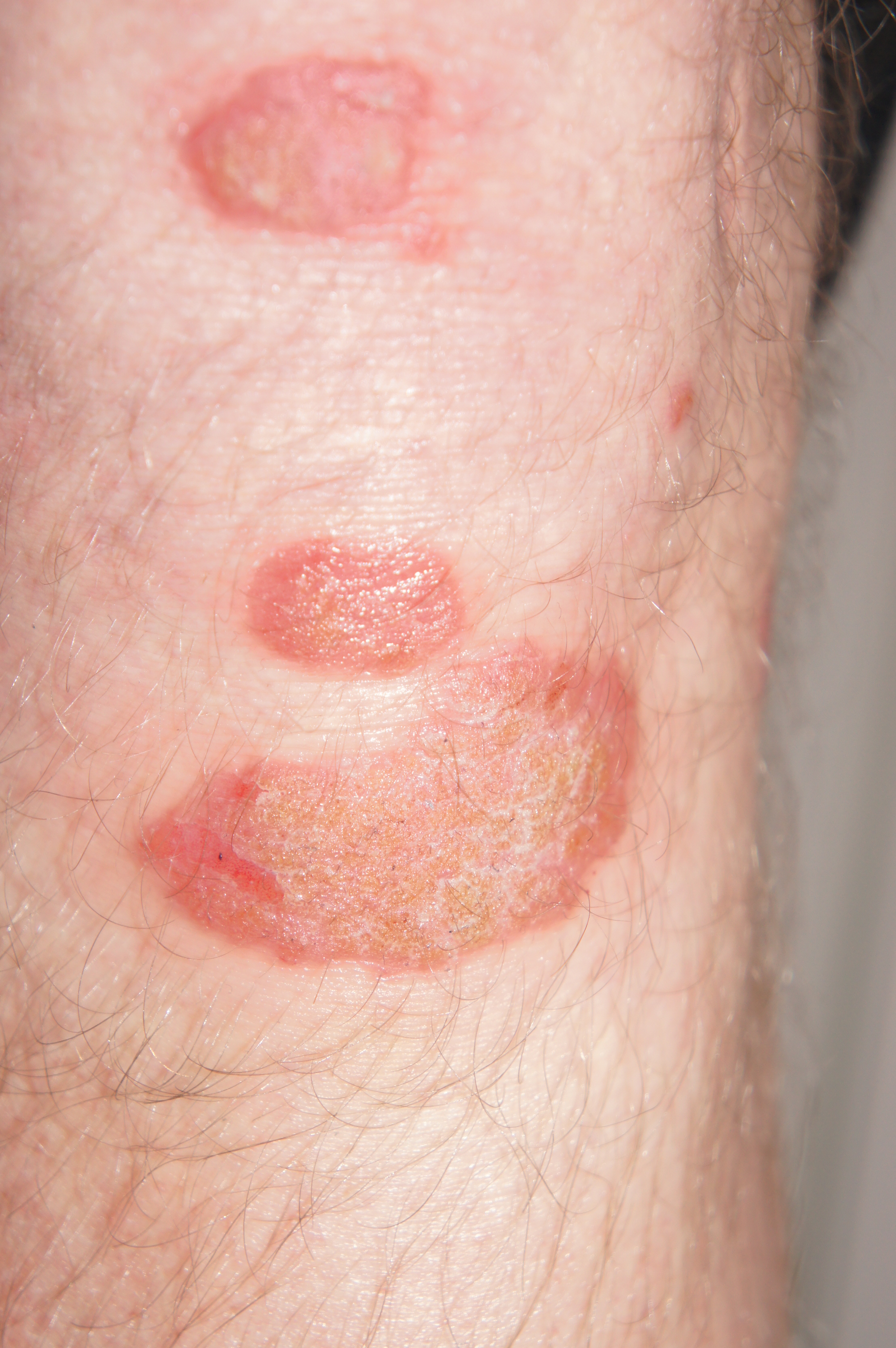 Psoriasis Pictures View Free Images of Psoriasis