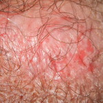 Scalp Psoriasis Picture